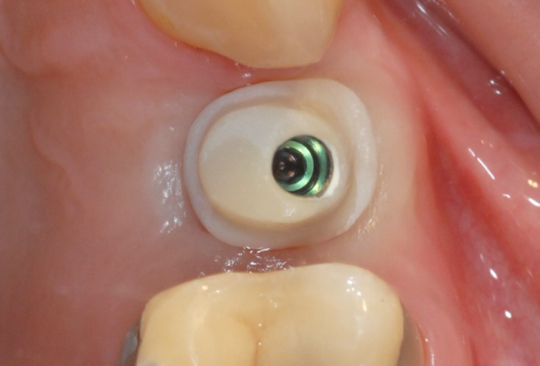 Ridge preservation with cerabone® and Jason® membrane - Dr. Derk Siebers