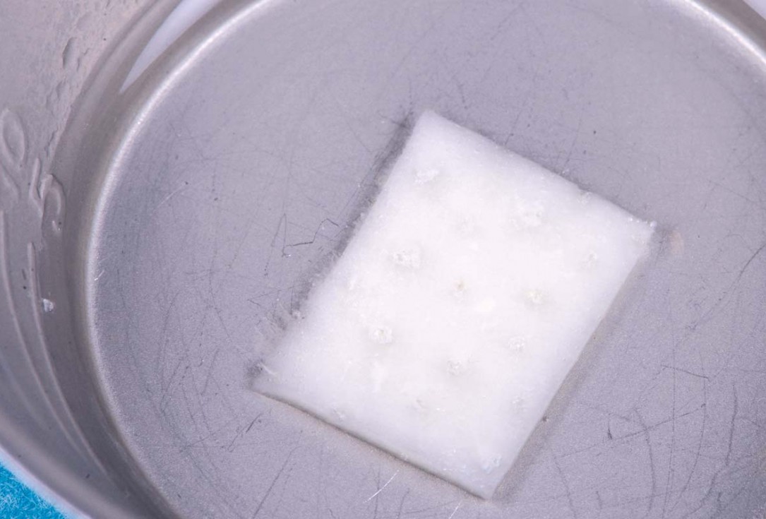 Excellent aesthetic result of buccal augmentation with mucoderm® and maxgraft® after immediate implant placement - 3-years follow-up - Dr. A. Puišys 