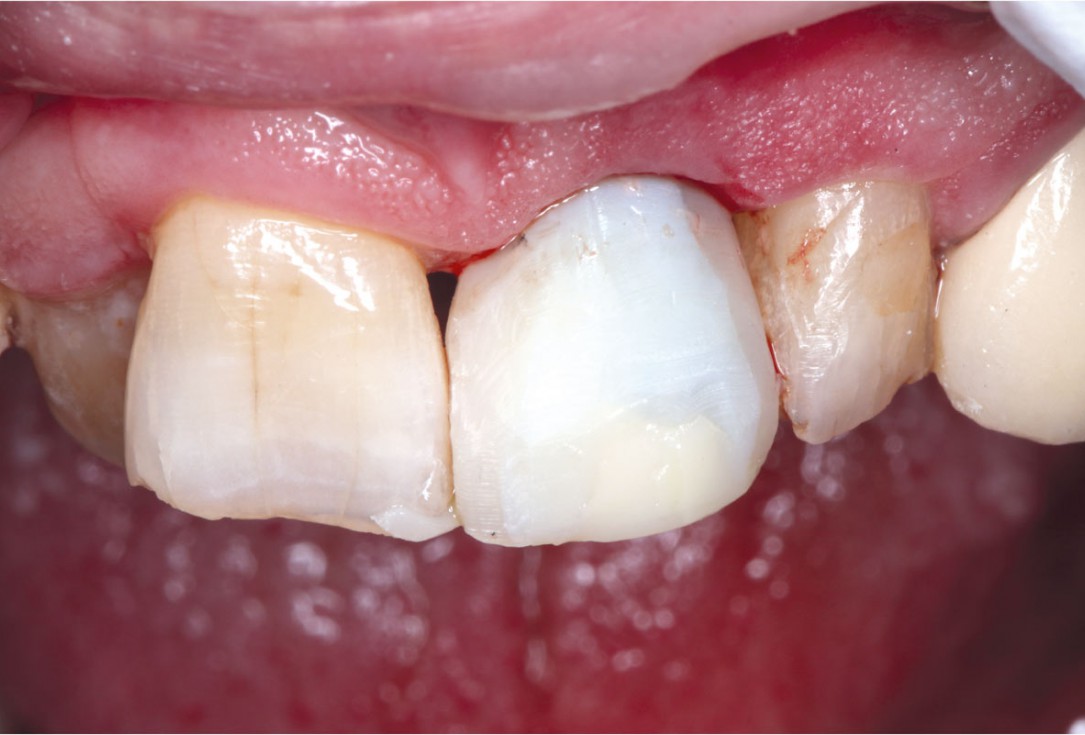 GBR using layering technique in aesthetic zone with maxgraft® and cerabone® -Dr. H. Maghaireh and Dr. V. Ivancheva