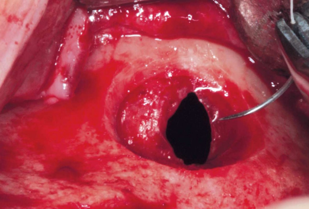 Maxillary sinus cyst removal using the Crocodile Technique and subsequent lateral sinus lift with cerabone®, maxgraft® and Jason® membrane - Dres. C. Scognamiglio and A. Perucchi 