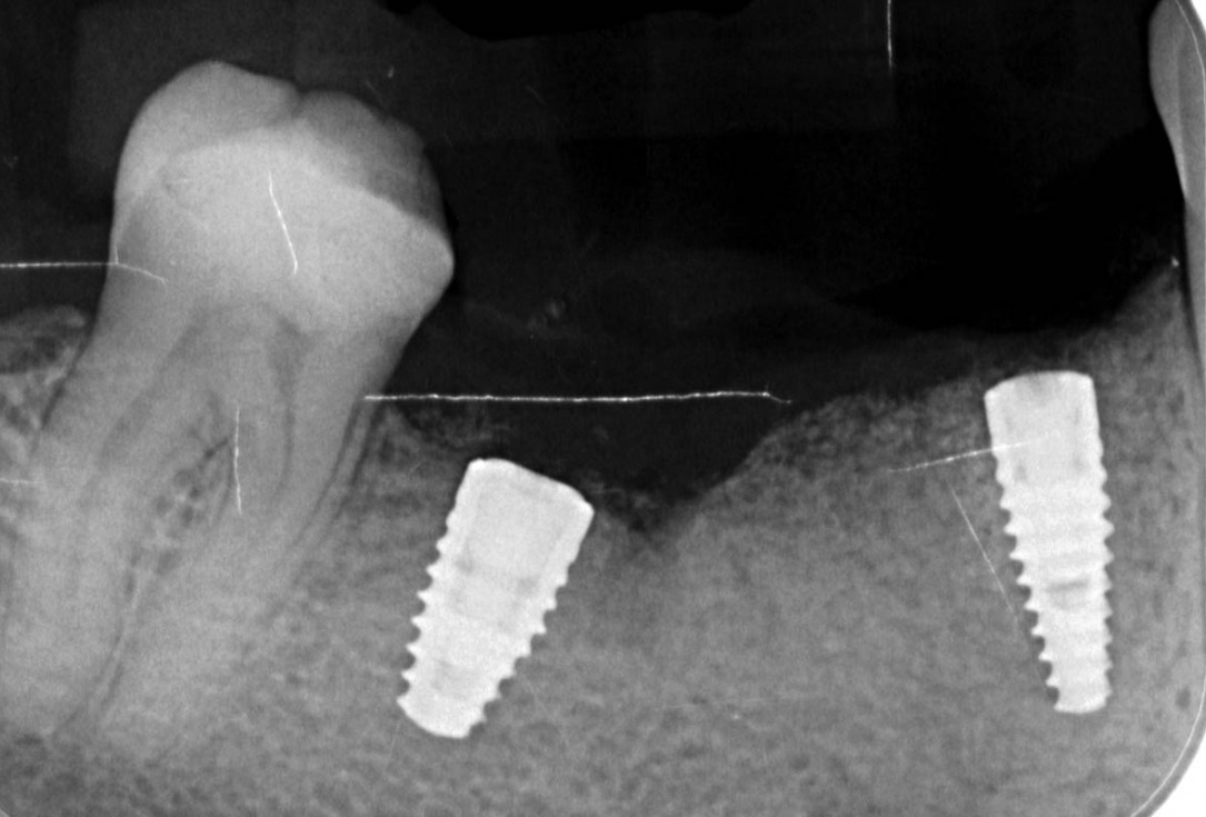 Vertical bone augmentation and broadening of attached gingiva using cerabone, permamem and mucoderm  -  Dr. R. Naimoli