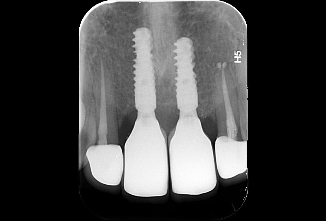 Ridge augmentation in the maxilla with maxgraft® bonebuilder in the aesthetic zone - Dr. M. Kristensen