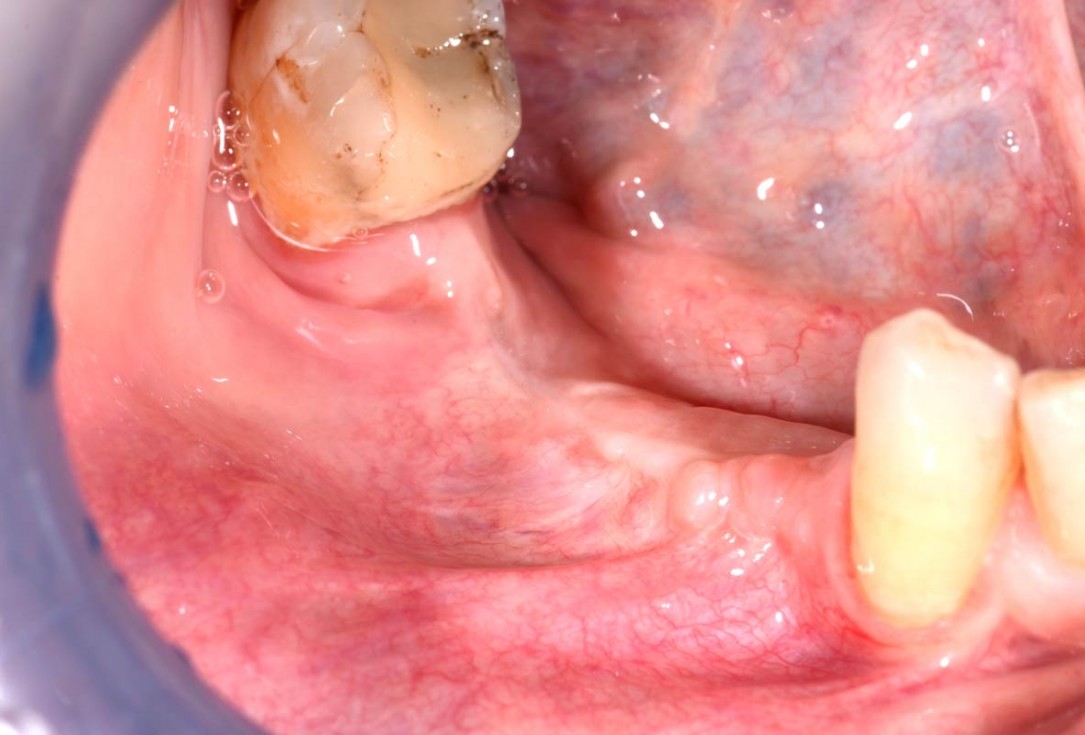 Vertical bone augmentation and broadening of attached gingiva using cerabone, permamem and mucoderm  -  Dr. R. Naimoli