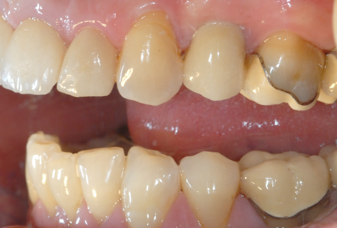 Ridge preservation with cerabone® and Jason® membrane - Dr. Derk Siebers