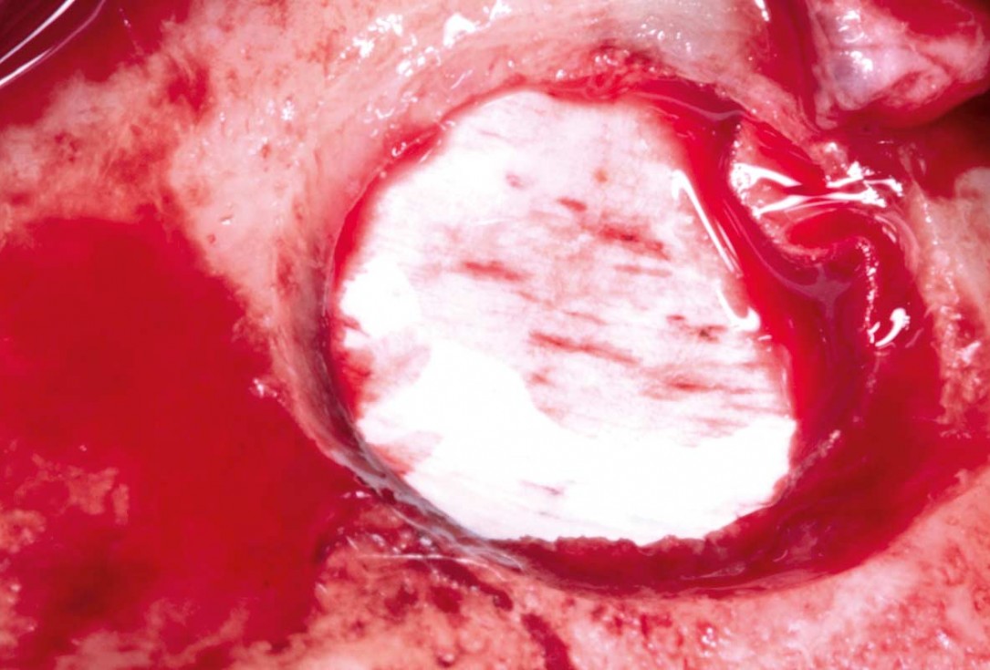 Maxillary sinus cyst removal using the Crocodile Technique and subsequent lateral sinus lift with cerabone®, maxgraft® and Jason® membrane - Dres. C. Scognamiglio and A. Perucchi 