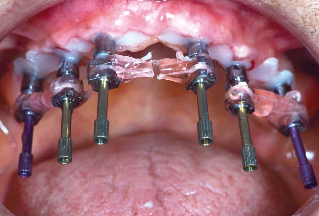 Full arch GBR using botiss cerabone®, maxgraft® and Jason® membrane with simultaneous implantation of 6 Straumann® implants - Dres. A. Signorio and G. Molina