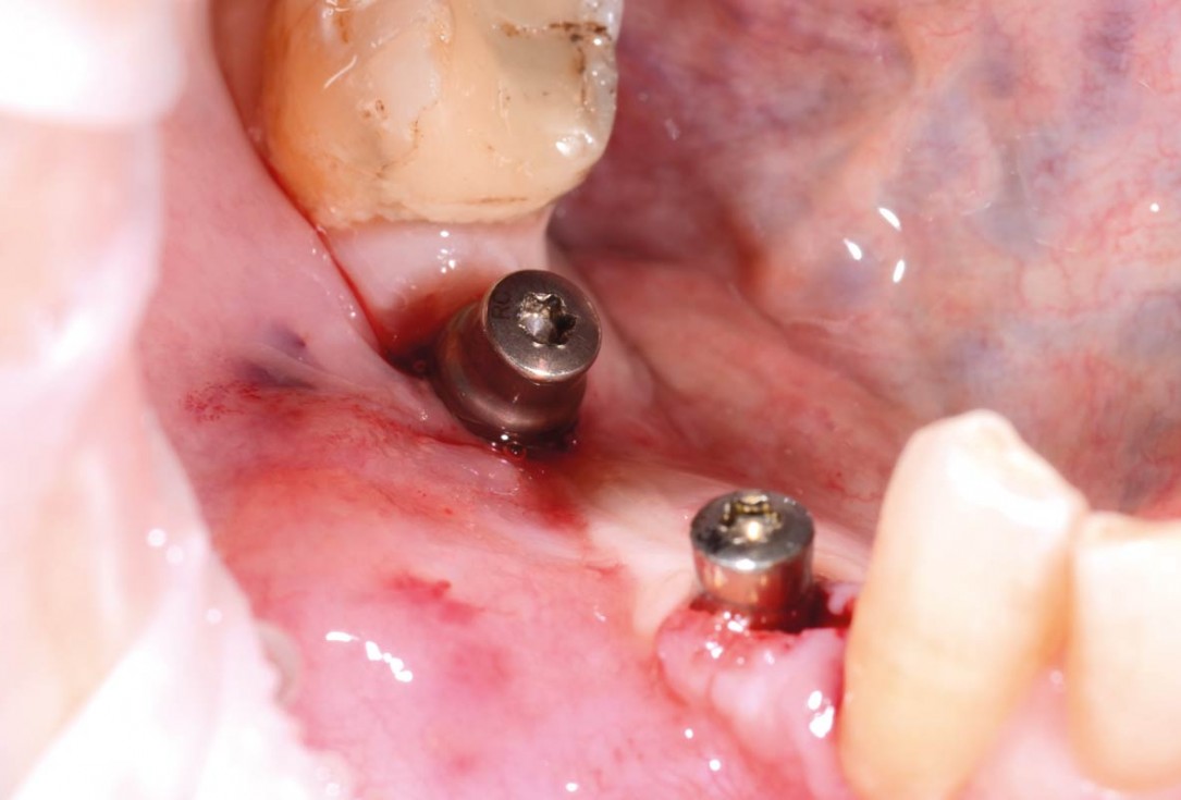 Vertical bone augmentation and broadening of attached gingiva using cerabone, permamem and mucoderm  -  Dr. R. Naimoli