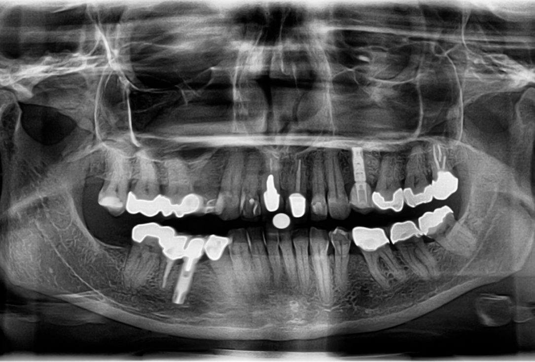 Ridge preservation with cerabone® and Jason® membrane - Dr. Derk Siebers