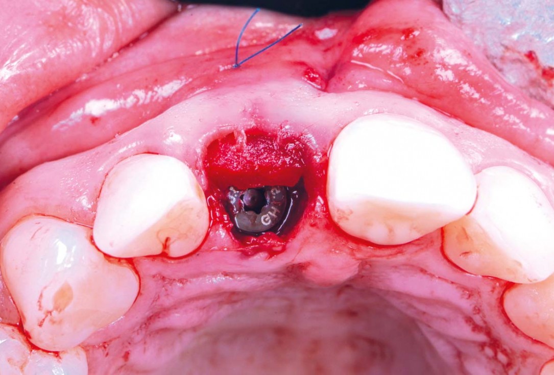 Excellent aesthetic result of buccal augmentation with mucoderm® and maxgraft® after immediate implant placement - 3-years follow-up - Dr. A. Puišys 