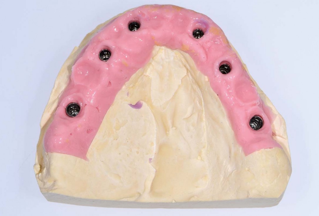 Full arch GBR using botiss cerabone®, maxgraft® and Jason® membrane with simultaneous implantation of 6 Straumann® implants - Dres. A. Signorio and G. Molina