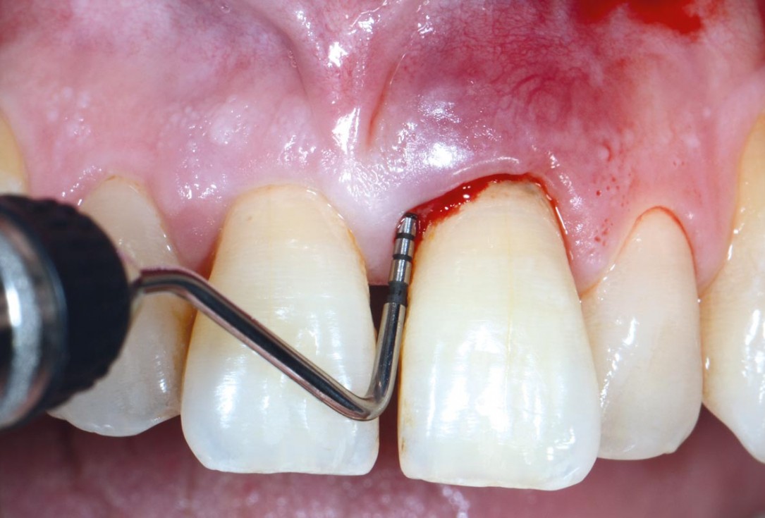EPP for the treatment of a deep intrabony defect 