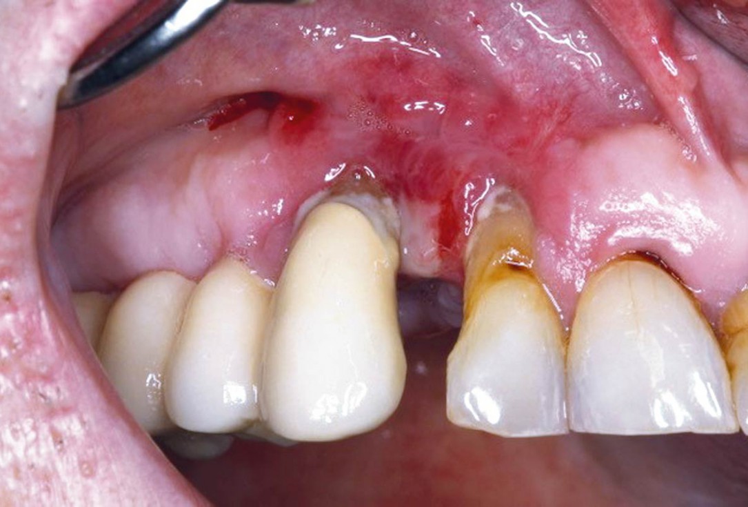 Regeneration with mucoderm® after fibroma resection