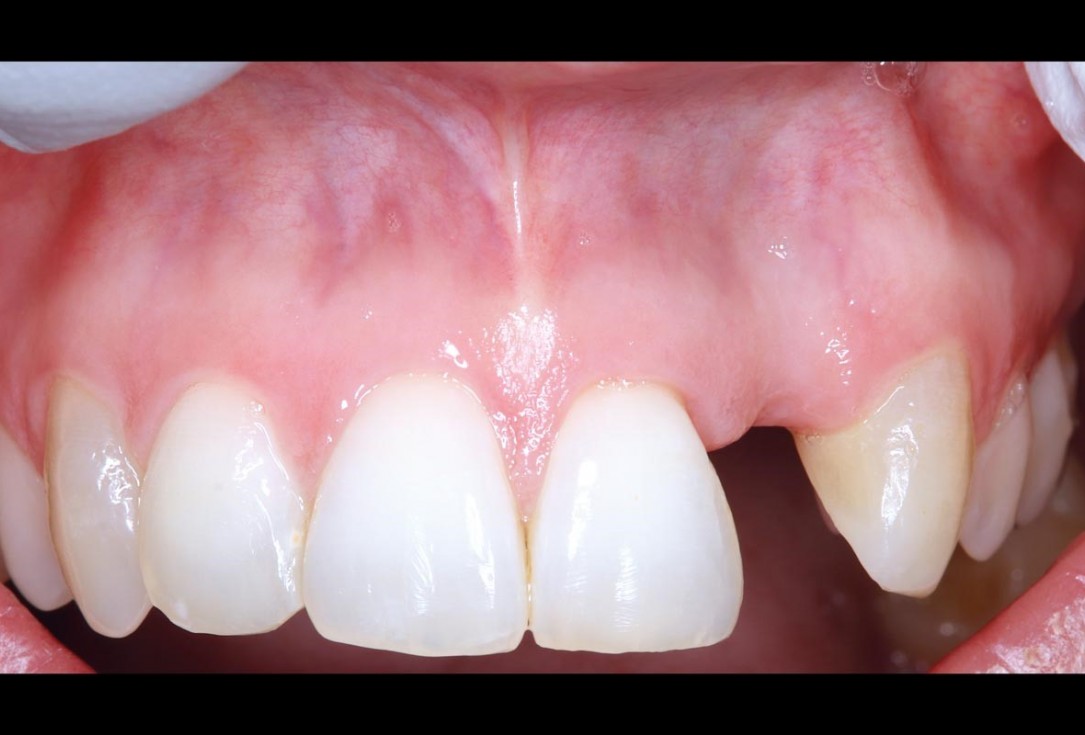 Simultaneous GBR and implantation using maxgraft® granules and autologous bone