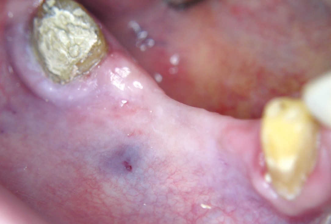 Horizontal ridge augmentation with maxgraft® cortico - M.Sc. E. Kapogianni