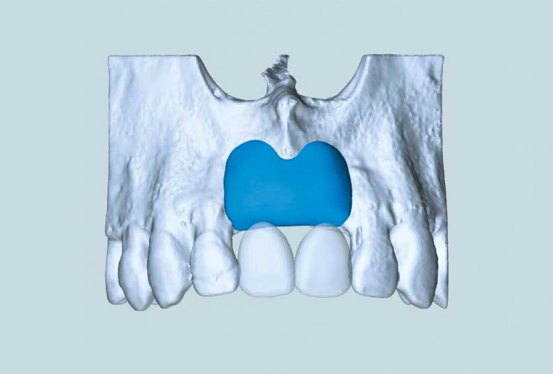 Ridge augmentation in the maxilla with maxgraft® bonebuilder in the aesthetic zone - Dr. M. Kristensen