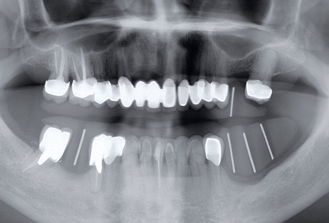 Ridge augmentation in the mandible with maxgraft® bonebuilder in a free-end situation - Dr. Dr. Dr. O. Blume