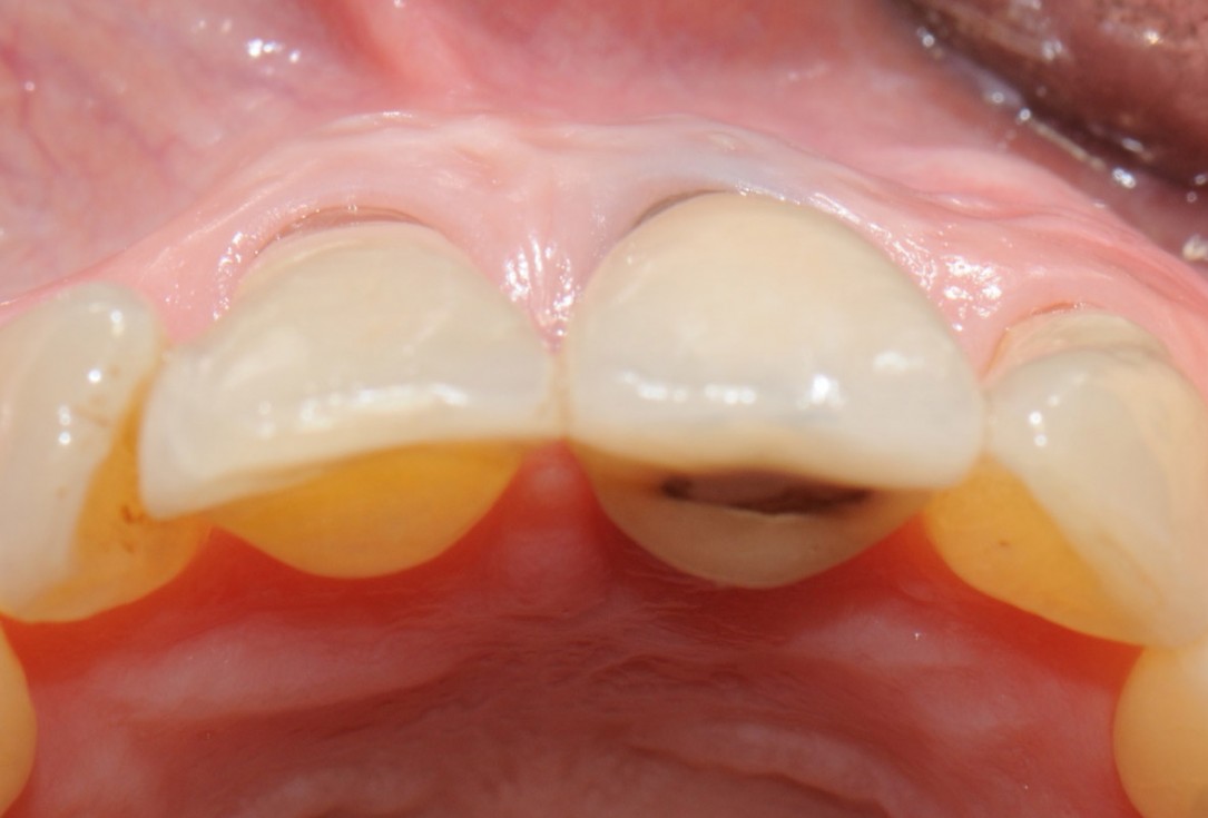 2/18 Tooth extraction and socket sealing with mucoderm® - Dr. A. Rossi