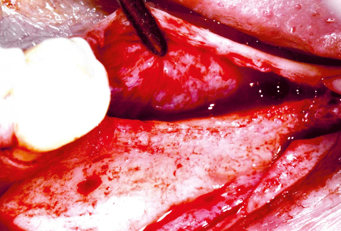 Ridge augmentation in the mandible with maxgraft® bonebuilder– Dr. R. Morger