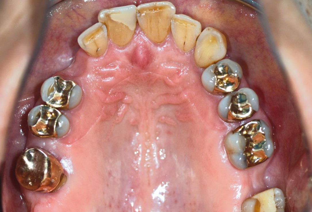 Block augmentation with maxgraft® in the maxilla - PD Dr. Dr. F. Kloss