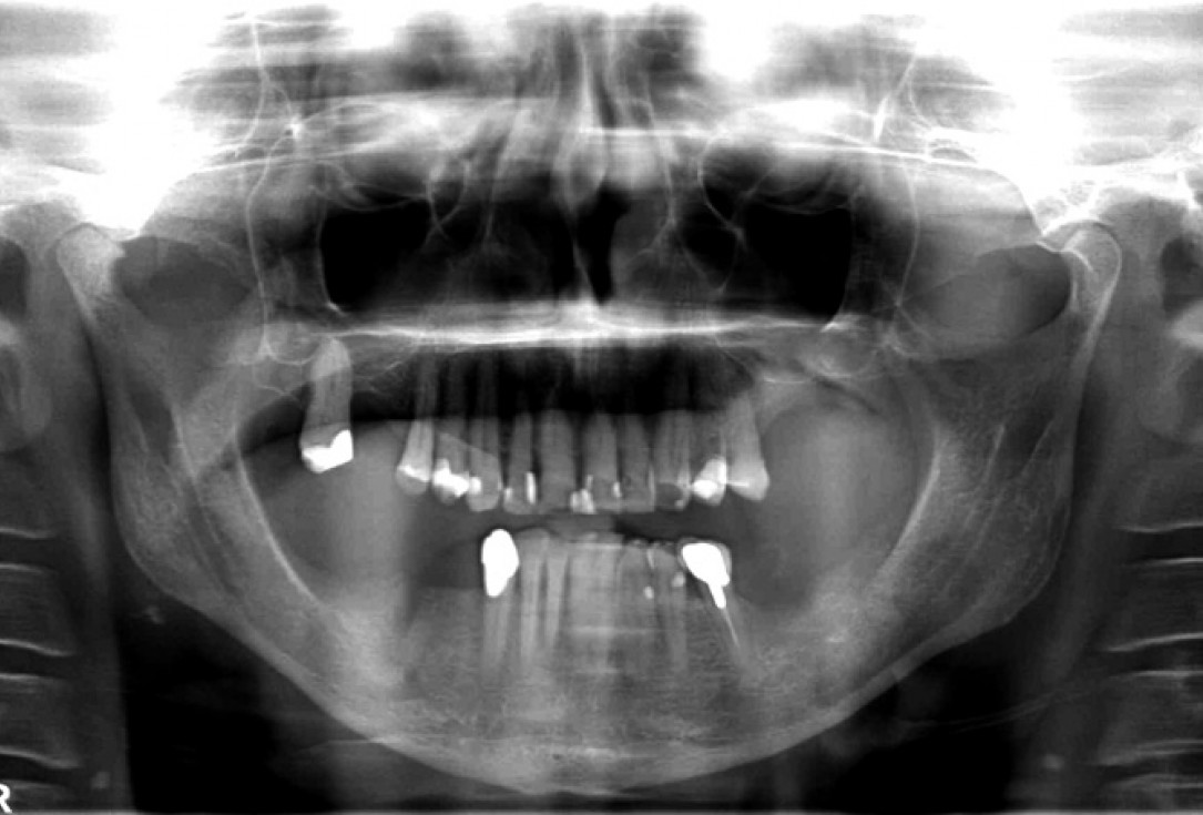 Block augmentation with maxgraft® in the mandible - PD Dr. Dr. F. Kloss