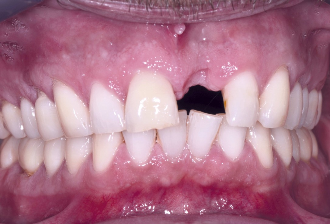 Block augmentation with maxgraft® and cerabone® – Dr. F. Kloss