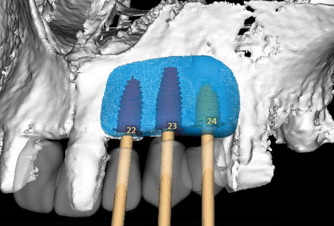 Reconstruction of Anterior Maxilla with maxgraft® bonebuilder – Dr. B. Han