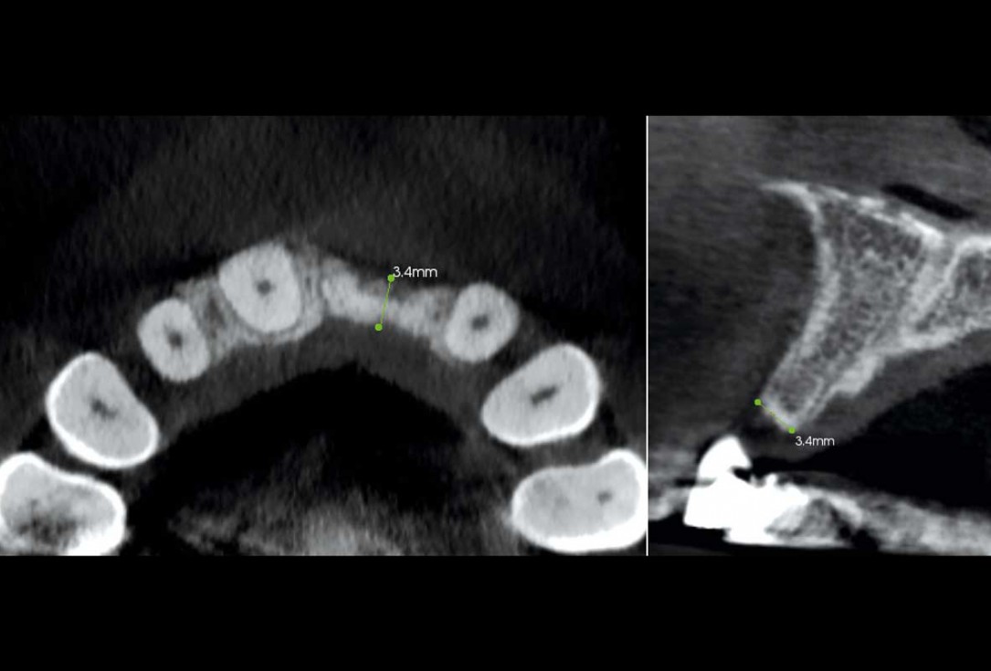 Block grafting in the aesthetic zone with maxgraft®, Jason® membrane and cerabone® - Dres. H. Maghaireh and V. Ivancheva