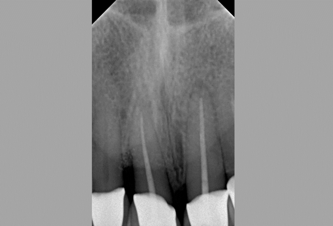 Non-contained intrabony defect treated by SPPF in conjunction with Straumann® Emdogain® and a particulate bone grafting material - Kasaj