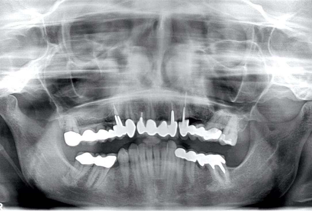 botiss maxgraft® bonebuilder for aesthetic zone reconstruction - Clinical case