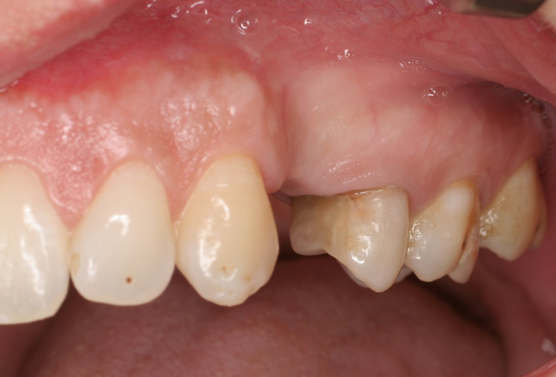 botiss cerabone® & Jason® membrane for horizontal augmentation - clinical case by Prof. Dr. Dr. D. Rothamel