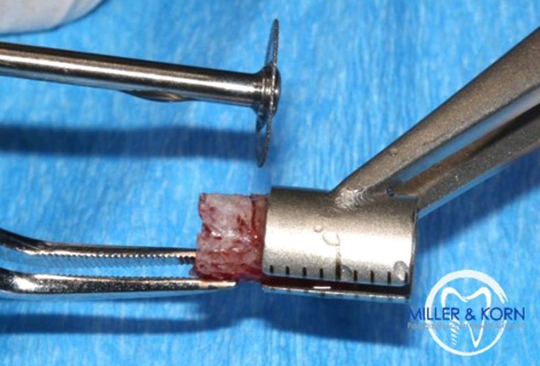 Immediate implant placement and correction of horizontal and vertical bone loss using an allograft bone ring, cerabone® and Jason® membrane - Drs. Miller and Korn