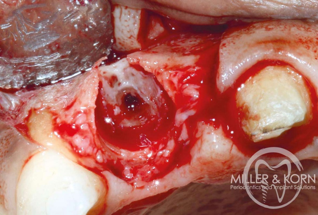 Immediate implant placement and regeneration of ridge using an allograft bone ring and Jason® membrane - Dr. Miller and Korn