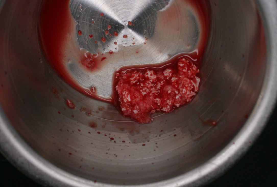 botiss cerabone® & Jason® membrane for horizontal augmentation - clinical case by Prof. Dr. Dr. D. Rothamel