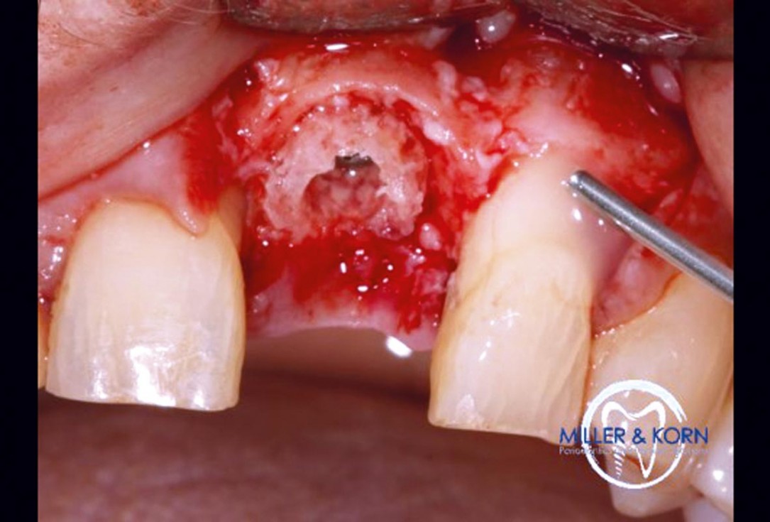 Immediate implant placement and correction of horizontal and vertical bone loss using an allograft bone ring, cerabone® and Jason® membrane - Drs. Miller and Korn