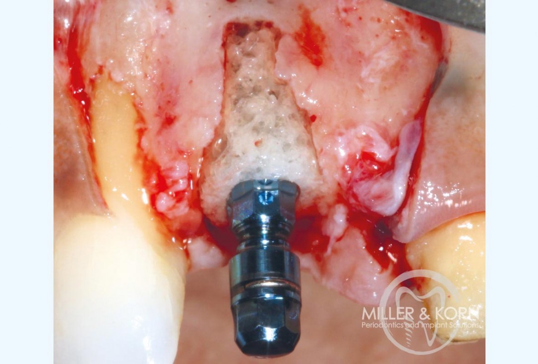 Immediate implant placement and regeneration of ridge using an allograft bone ring and Jason® membrane - Dr. Miller and Korn