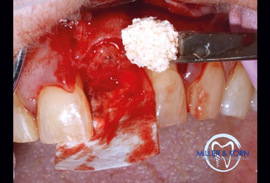Immediate implant placement and correction of horizontal and vertical bone loss using an allograft bone ring, cerabone® and Jason® membrane - Drs. Miller and Korn