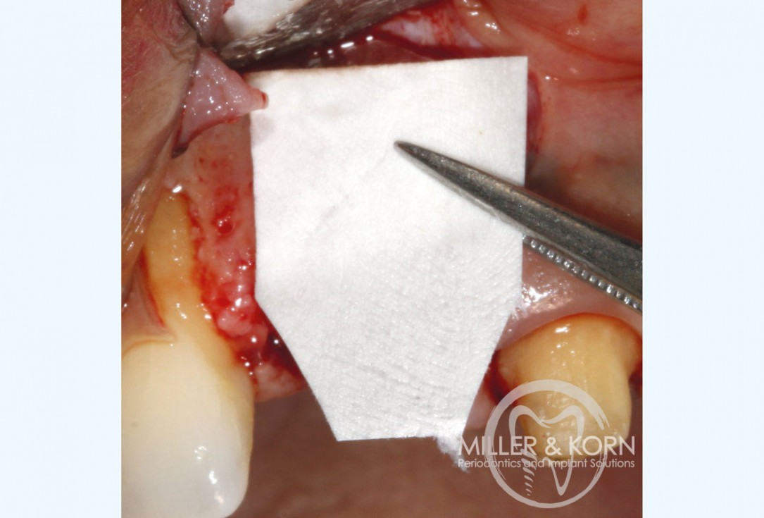 Immediate implant placement and regeneration of ridge using an allograft bone ring and Jason® membrane - Dr. Miller and Korn