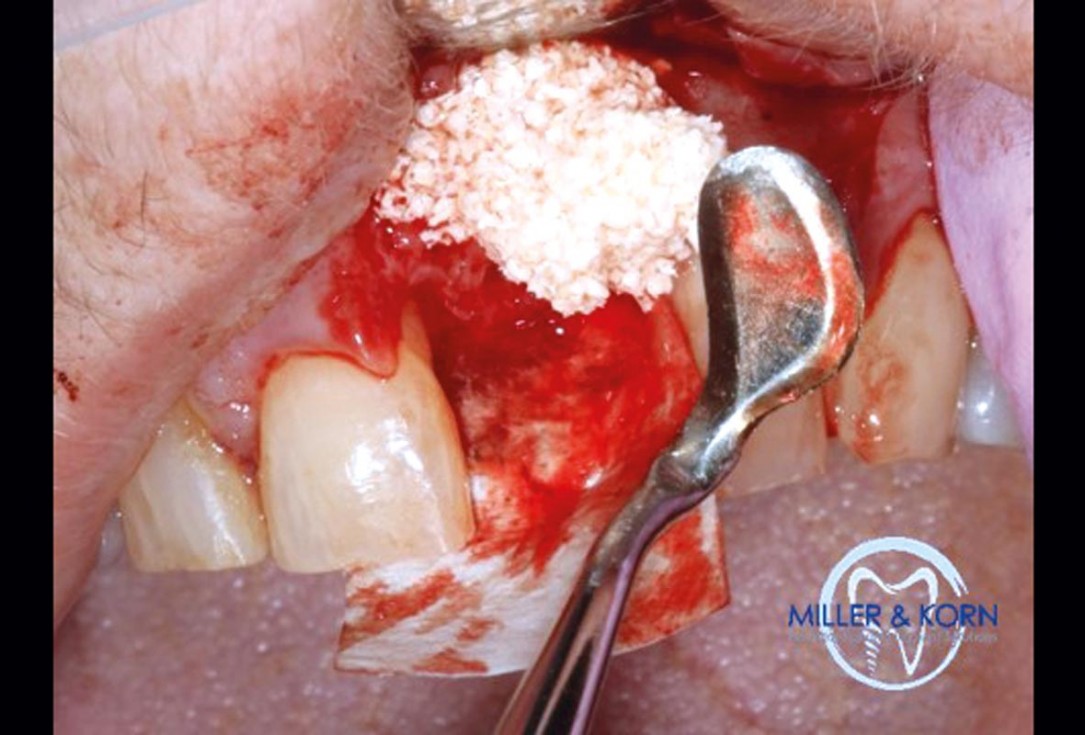 Immediate implant placement and correction of horizontal and vertical bone loss using an allograft bone ring, cerabone® and Jason® membrane - Drs. Miller and Korn
