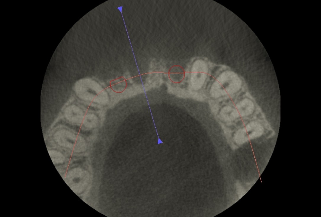 Block augmentation with maxgraft® block and mucoderm® - Dr. K. Chmielewski