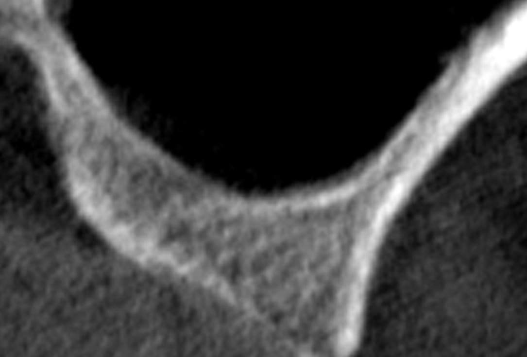 Sinus lift with simultaneous implantation with cerabone® and collprotect® membrane - clinical case Dr. Victor Kalenchuk