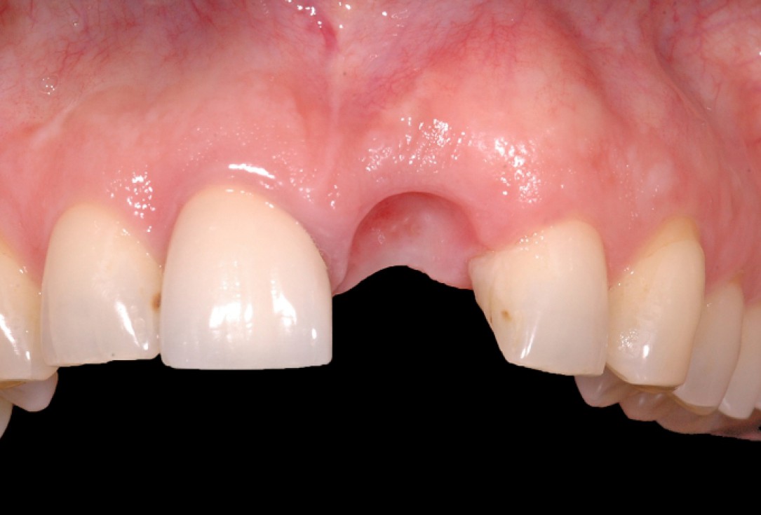 GBR together with soft tissue augmentation with mucoderm® and maxresorb® - Scherg