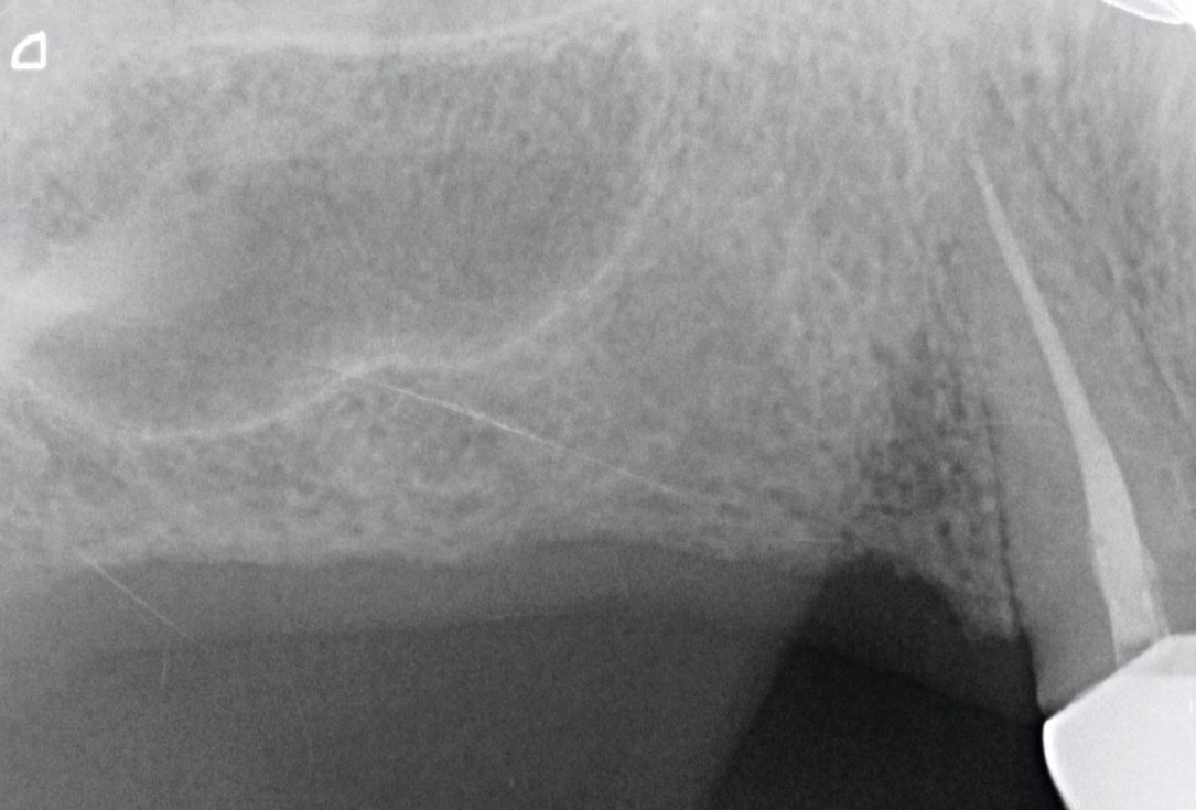 GBR with Jason membrane® and cerabone® - D. Fontana