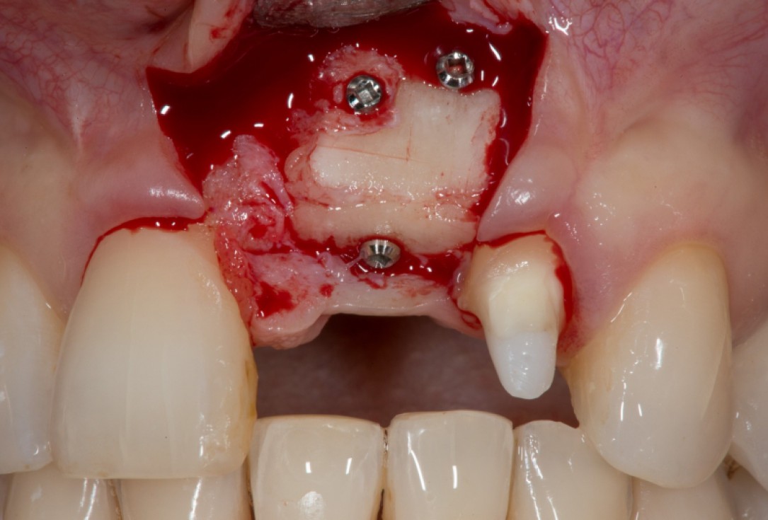 Augmentation with maxgraft® cortico - Dr. K. Chmielewski