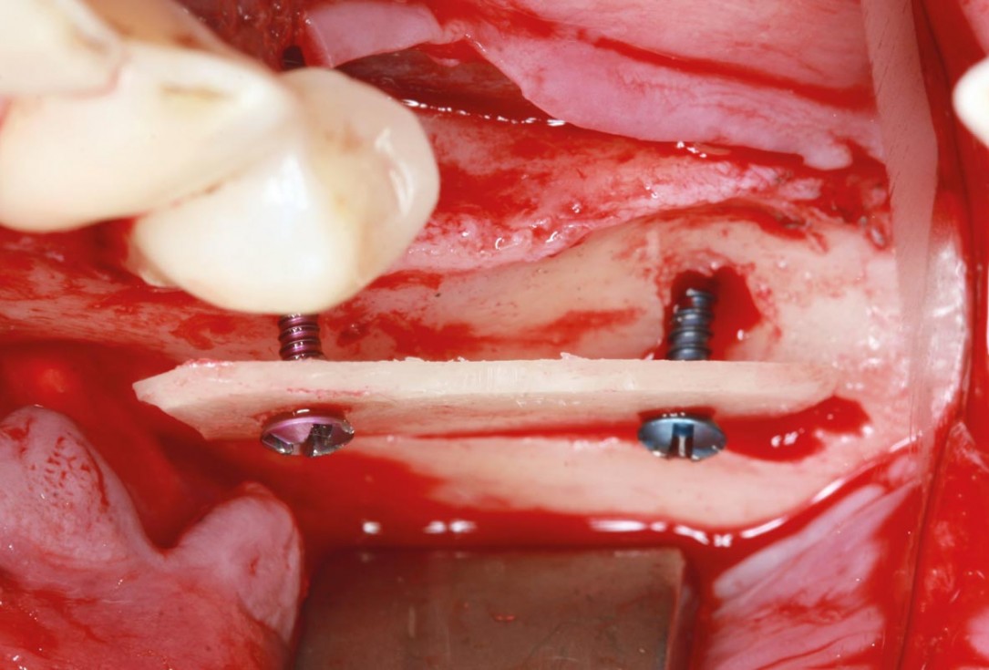 maxgraft® cortico at free-end situation in the mandible - J. Kielhorn