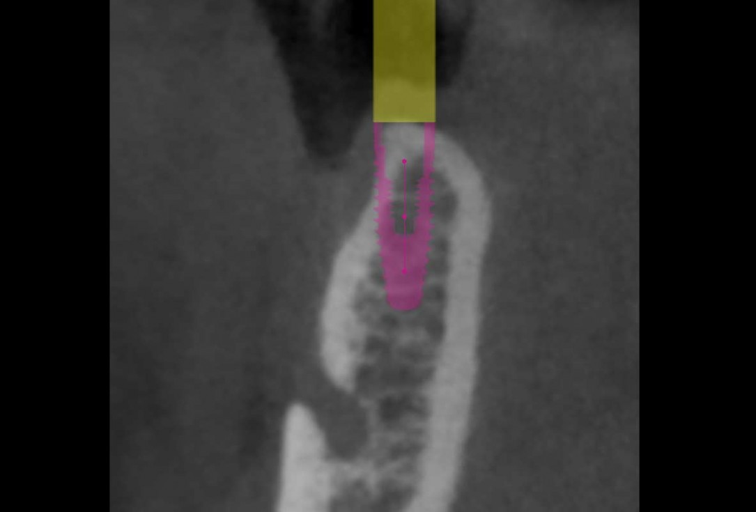 Reconstruction of a single tooth defect with the shell technique - Dr. Andoni Jones