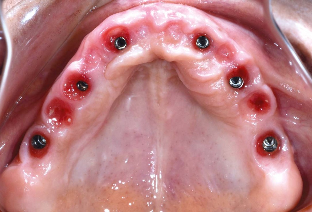 Full arch GBR using botiss cerabone®, maxgraft® and Jason® membrane with simultaneous implantation of 6 Straumann® implants - Dres. A. Signorio and G. Molina