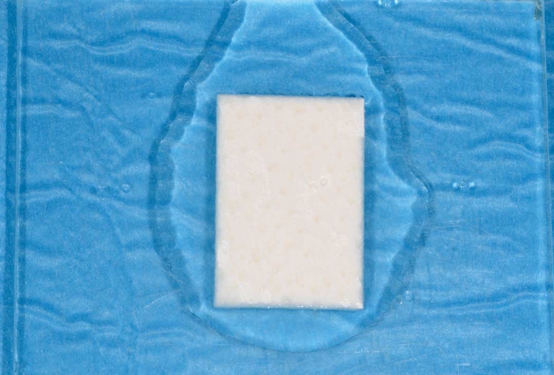 Vertical bone augmentation and broadening of attached gingiva using cerabone, permamem and mucoderm  -  Dr. R. Naimoli