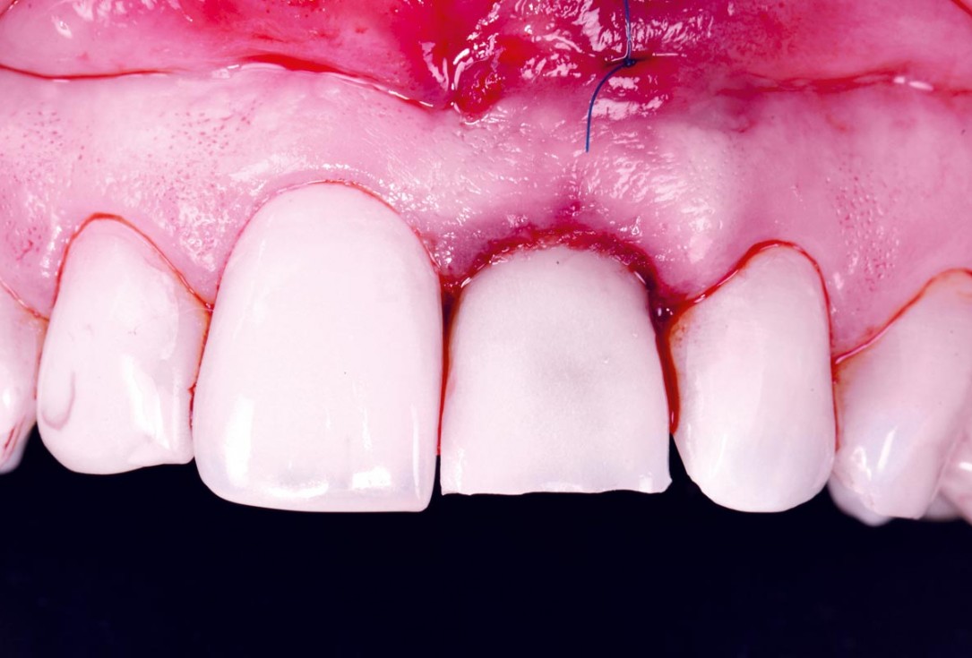 Excellent aesthetic result of buccal augmentation with mucoderm® and maxgraft® after immediate implant placement - 3-years follow-up - Dr. A. Puišys 