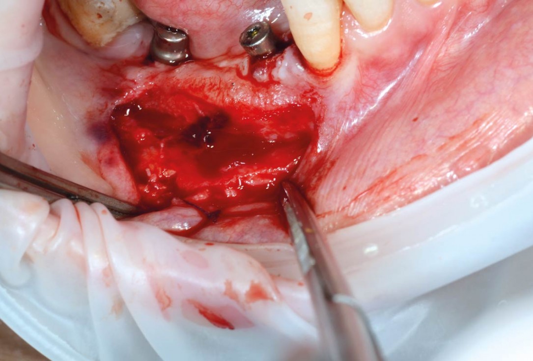 Vertical bone augmentation and broadening of attached gingiva using cerabone, permamem and mucoderm  -  Dr. R. Naimoli