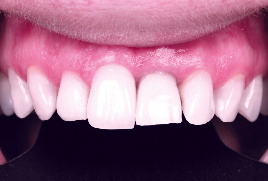 Excellent aesthetic result of buccal augmentation with mucoderm® and maxgraft® after immediate implant placement - 3-years follow-up - Dr. A. Puišys 